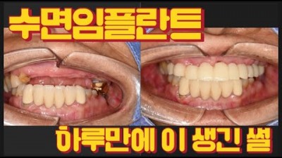수면임플란트 수면치과 임플란트비용 무서운치과 치과치료 꿀팁