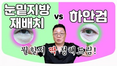 하안검, 눈밑지방재배치 눈성형 차이점, 눈밑꺼짐 눈밑주름 애교살 수술시술 가격 비용