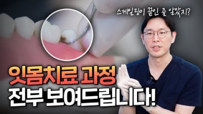 치주질환 스케일링 잇몸치료 진단방법 치료방법 치료과정